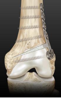 Visualização da Placa para Osteotomia Tibial com parafusos esponjosos e corticais Visualização da Placa