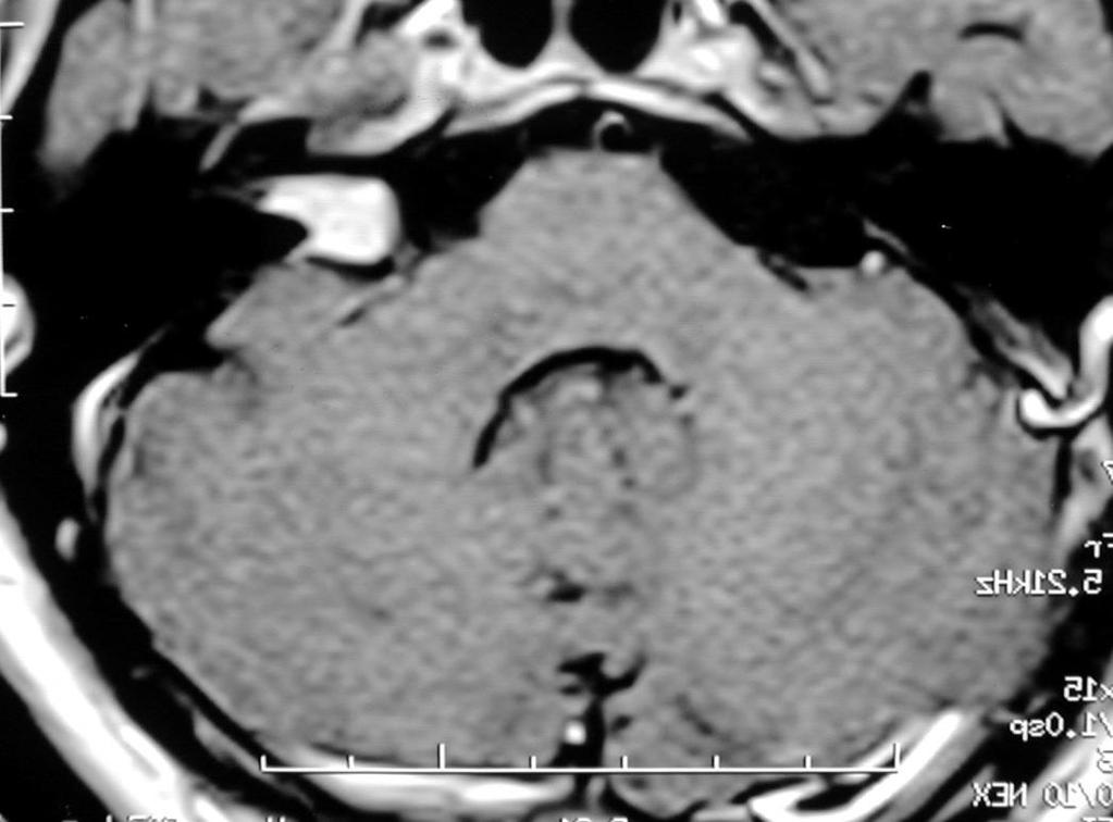 NEURINOMA DO