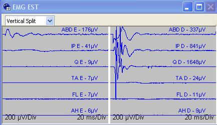 PF T12 Dir EMG