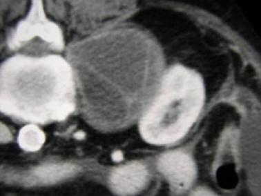 A chave para o diagnóstico destas lesões é a observação de que estas massas têm um realce após contraste idêntico ao do restante parênquima renal.