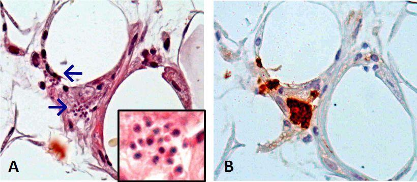 27 Figura 3. A: Biópsia de pele mostrando ninhos de formas amastigotas de T. cruzi no citoplasma de macrófagos (setas). Hematoxilina e eosina, 400X.