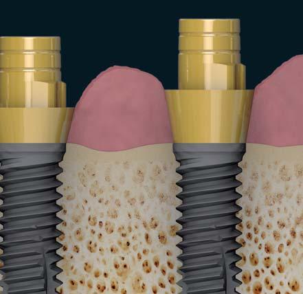 implanto suportadas aparafusada incluíndo na zona anterior.