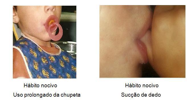 Hábitos viciosos Naturalmente a presença da fissura já predispõe a uma maior aerofagia, sendo necessário que se faça mais pausas e que se tenha o cuidado em manter o bico da mamadeira sempre