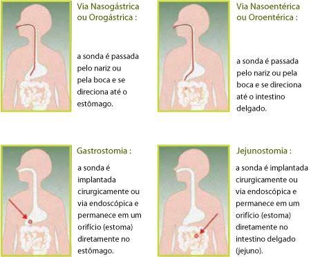 Os reflexos de fechamento de mandíbula, vômito, sucção e deglutição estão alterados desde a vida intra-uterina, portanto o trabalho de sensibilidade proprioceptiva oral