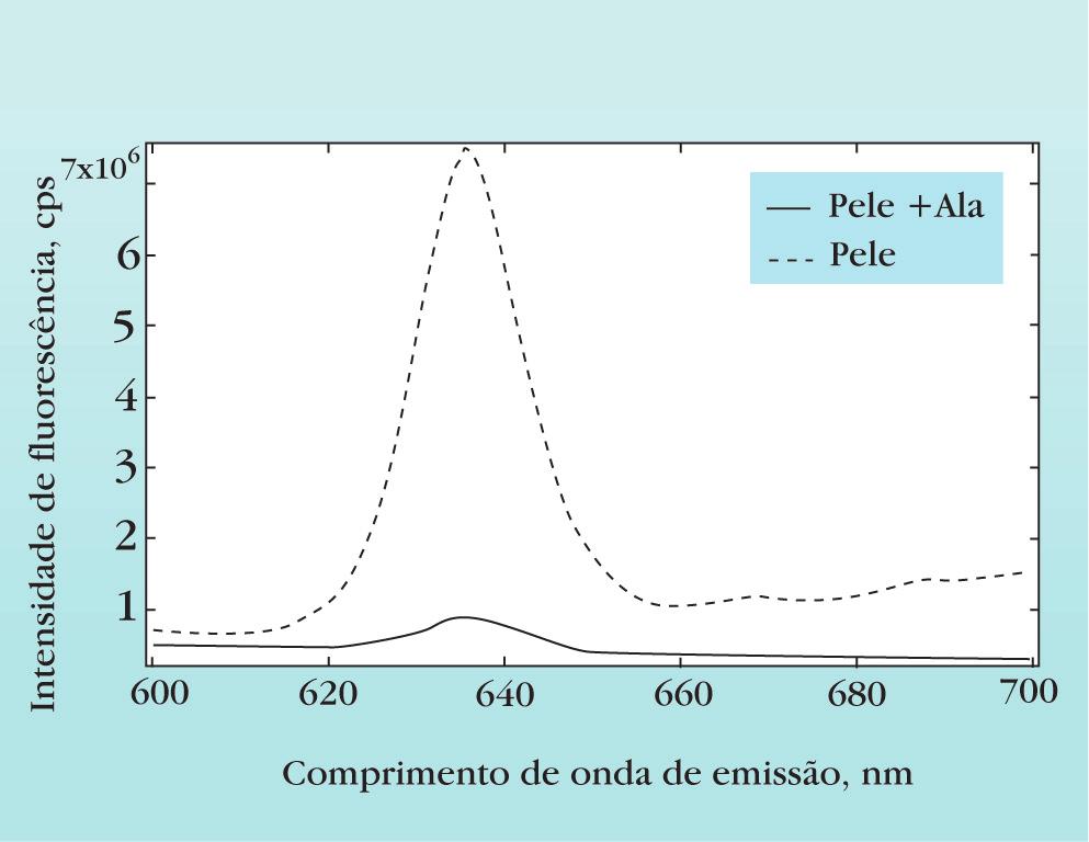 312 Felício LBA, Ferreira J, Bentley MVB, Bagnato VS, Tedesco AC, Souza CS GRÁFICO 1: Curva da intensidade de emissão de fluorescência da PpIX na disceratose de Bowen FIGURA 1: Disceratose de Bowen