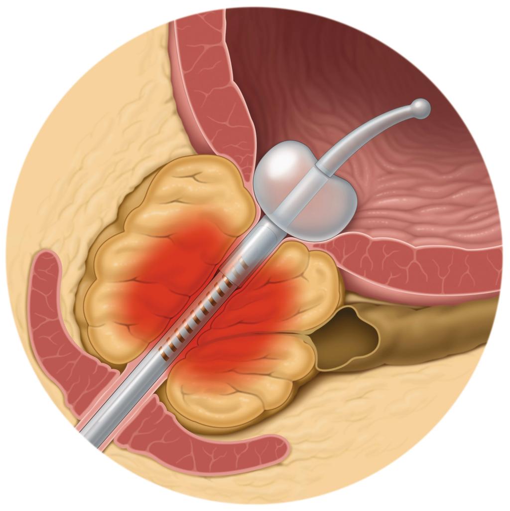 Terapia transuretral por micro-ondas (TUMT) A terapia transuretral por micro-ondas (TUMT) da próstata é um tratamento minimamente invasivo que utiliza a energia das micro-ondas para endurecer partes