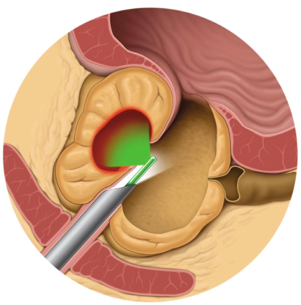 Tratamento a Laser Os tratamentos com laser são uma opção de tratamento comum para a HBP. O laser usa luz intensa para cortar ou vaporizar o tecido prostático.