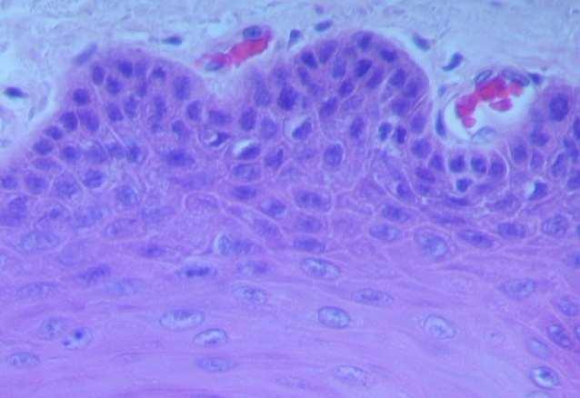 para-basal e núcleos pequenos com predomínio de citoplasma acidófilo nas células mais