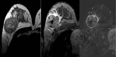 Verificou-se evidente necrose intratumoral. T2_SE T1_fs_Gd Sub_Gd Fig. 12 - Mulher, 35 anos, apresentava sinais inflamatórios da mama direita.