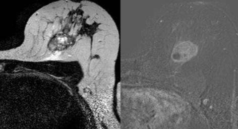 parede anterior e posterior. Histologia: Carcinoma ductal invasor GIII, triplo-negativo. Fig. 11 - Mulher, 38 anos, ecografia.