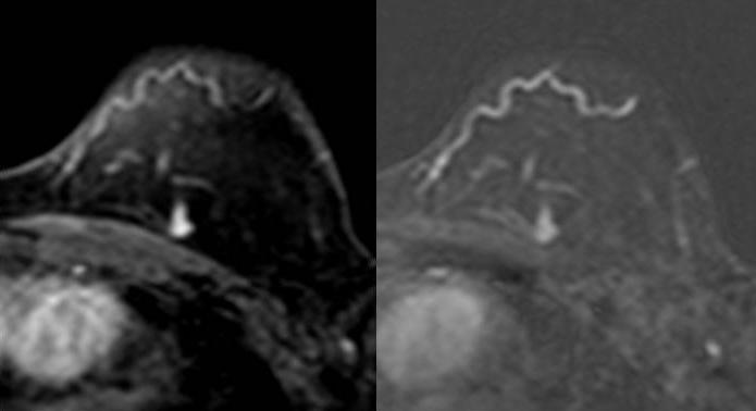 T1_fs_Gd Sub_Gd Fig. 15 - Mulher, 55 anos, Nódulo profundo, Ca ductal invasor GII, triplo-negativo captação persistente.