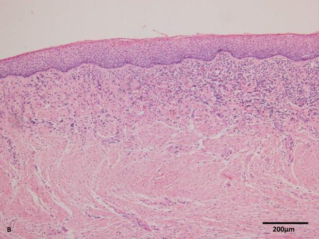 infiltrado inflamatório. A - Antes da descompressão observa-se apenas células inflamatórias ocasionais (40x) (H&E - Escala 100 µm).