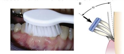 *TÉCNICA DE BASS CARRANZA JÚNIOR, F. A.; NEWMAN, M. G.; TAKEI, H. H. (2004). 1 - Escova extra macia, posicione as cerdas da escova na área entre as bordas da gengiva e o dente em um ângulo de 45.