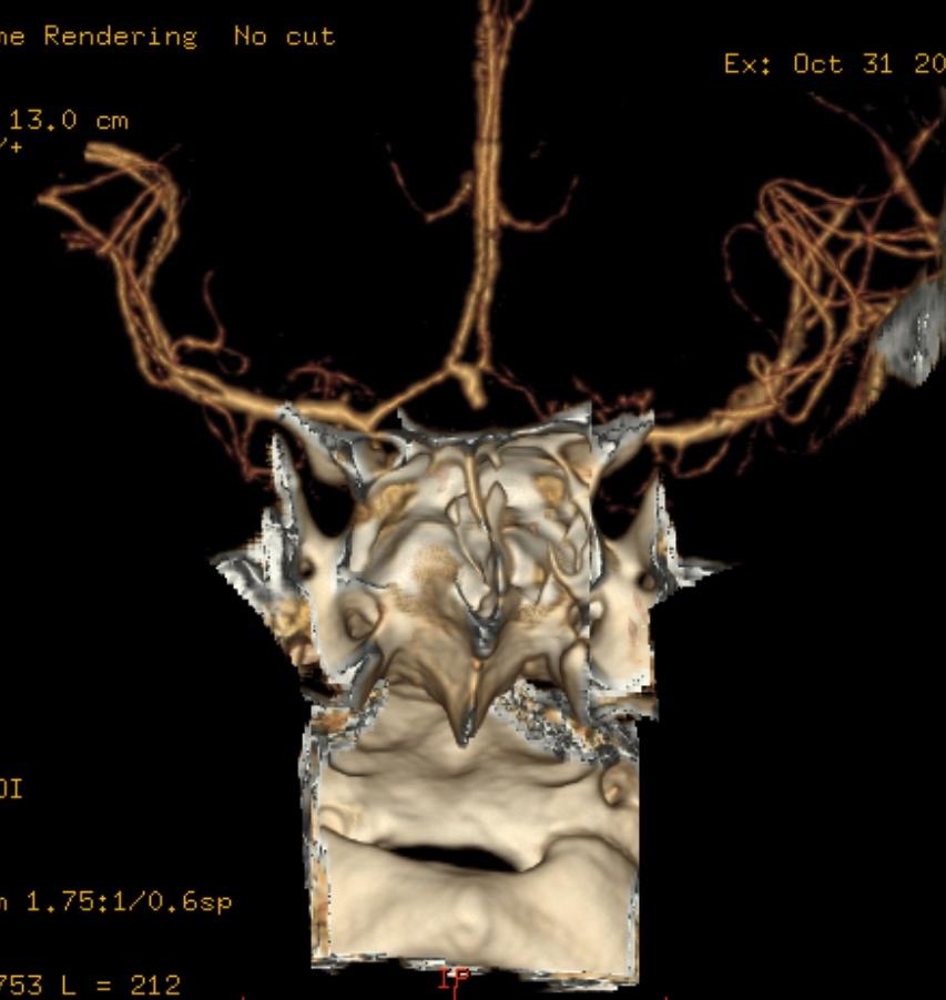 anterior (seta). (A): MIP (B): Reconstrução 3D Caso 3 (nr.