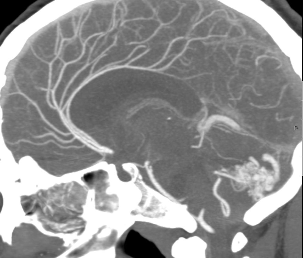 Imagens de Angiografia convencional da