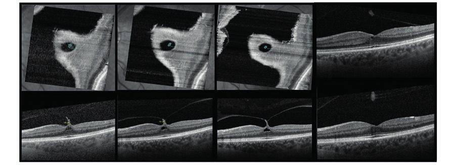 Ocriplasmina nas tracções vitreomaculares: a experiência do nosso serviço A B C D A 2 B 2 C 2 E Fig.