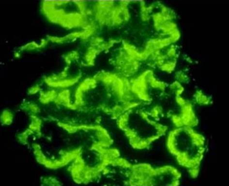 jpg Quando o padrão é granular evidencia-se outra patologia glomerular cujo diagnóstico exige a técnica de imunofluorescência que é a Glomerulopatia de
