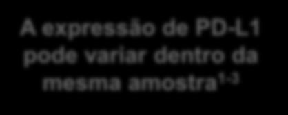 Complexidade Biológica: Heterogeneidade Intratumoral A expressão de PD-L1 pode variar dentro