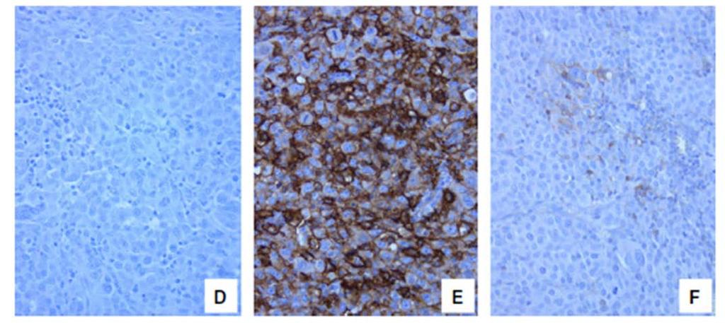 Complexidade Biológica: Heterogeneidade Intertumoral Melanoma primário Meta Linfonodo Meta cerebral Adapted from Madore et al.