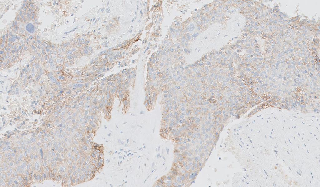 Teste de PD-L1 70% PD-L1 expression Stained images from PD-L1 IHC 28-8 pharmdx with permission from Dako Denmark A/S.