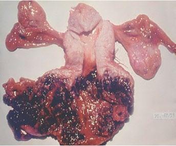 Histerectomia feita por quimiorresistência Figura 5. Tumor trofoblástico do sítio placentário.