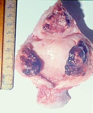 Doença trofoblástica gestacional Figura 6. Tumor trofoblástico epitelioide. Pode-se observar área neoplásica uterina.