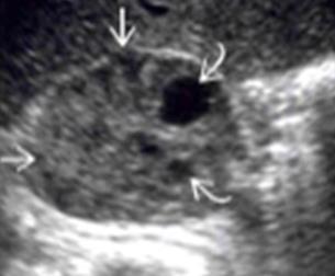 Figura 1: Ultrassonografia do abdômen Ultrassonografia abdominal: massa em topografia da adrenal esquerda, de limites definidos, levemente heterogênea, com pequenas áreas liquefeitas de permeio.
