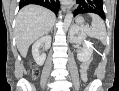 Figura 2A (corte axial): lesão expansiva adrenal esquerda (seta) apresentando impregnação predominantemente periférica de meio de contraste, notandose áreas