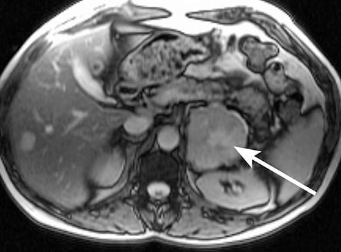 Figuras 3A e 3B: Ressonância magnética (RM) do abdômen Ressonância magnética em T2: sinais hiperintensos no centro de lesão expansiva adrenal esquerda.