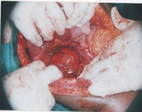 Adrenalectomia aberta foi realizada através de incisão subcostal esquerda. A veia adrenal foi ligada e o tumor removido (Figura 4).