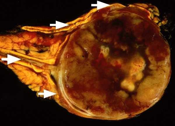 Figura 5 Microscopia (Figuras 6 a 10): Os cortes histológicos, corados pelo método de hematoxilina & eosina, mostram glândula suprarrenal apresentando neoplasia de celularidade moderada,