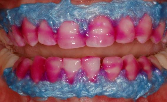 20 SC, Brasil), permaneceu por 40 minutos em contato com a superfície vestibular dos dentes (figura 3b).