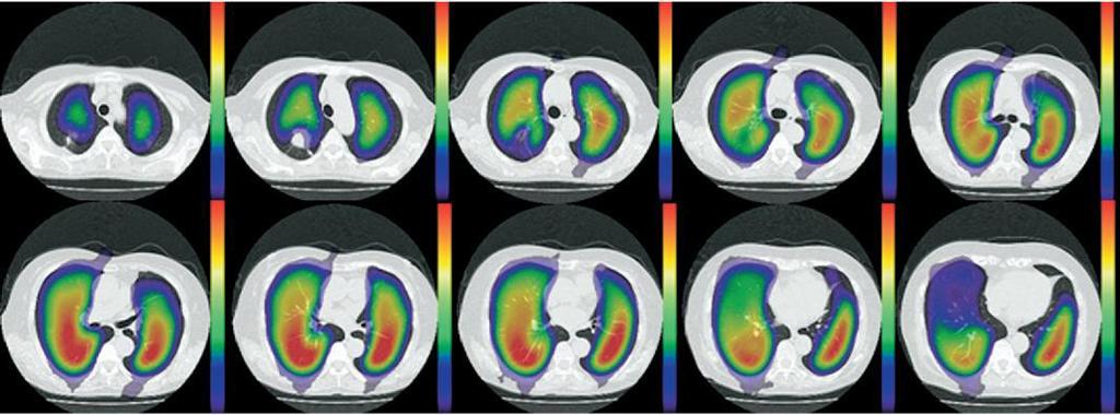 PREDITOS PÓS-OPERATÓRIOS: SPECT-TC Maior acurácia em predizer a função pulmonar