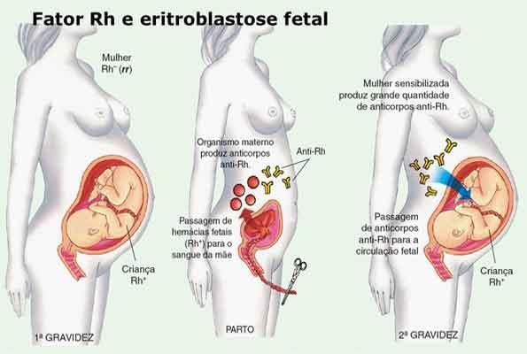 Eritroblastose fetal ou Doença hemolítica do recém-nascido Ocorre quando há mulheres Rh- sensibilizadas para o Rh+, seja por transfusão ou por gravidez prévia de um feto Rh+, que estão gerando um