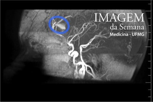 Imagem 3: Angioressonância (angio-rm) arterial 3D time-of-flight (3D TOF), que promove contraste entre as estruturas vasculares com fluxo e o tecido estacionário em uma única aquisição.