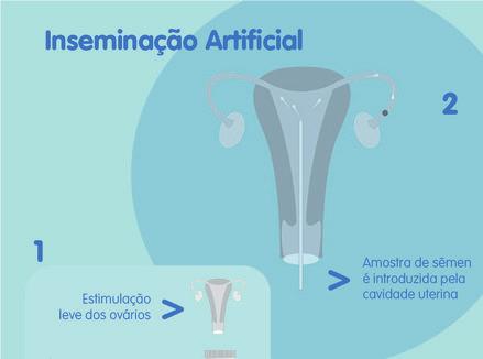 Diferença entre Inseminação Artificial e Fertilização in Vitro A diferença básica entre a Inseminação Artificial e a Fertilização in Vitro dito de forma simplificada é que na primeira, a fecundação