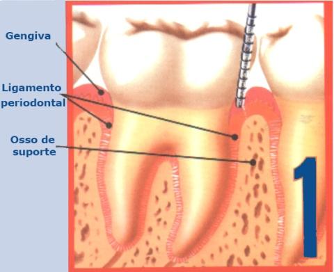 4 Fonte: figura adaptada de www.doencaperiodontal.com.br Figura 1 Estágios da doença periodontal: 1. gengiva normal; 2. gengivite; 3. periodontite.