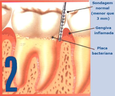 Este estudo sugere que a doença periodontal poderia levar a um aumento do risco cardiovascular, a partir das alterações do perfil lipídico associadas a ela, mesmo em indivíduos com baixo