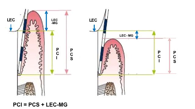 13 O índice de PCS foi determinado através da introdução de uma sonda periodontal no sulco gengival, obtendo-se uma medida da margem gengival até o fundo do sulco.