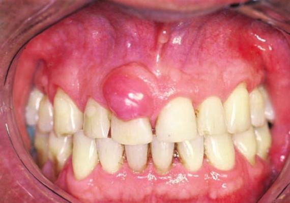 (2004) citaram a região vestibular da mandíbula como maior ocorrência, e Freitas et al. (2004) e Moreti et al., (2016) relataram casos clínicos de FOP na mandíbula.