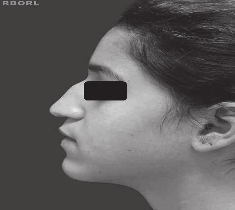 As figuras 1 a 6 demonstram pré e pós-operatório de uma paciente pertencente ao Grupo 4 (maior prevalência), 17 anos, sexo feminino, pele de espessura normal, que apresentava ponta nasal com ângulo