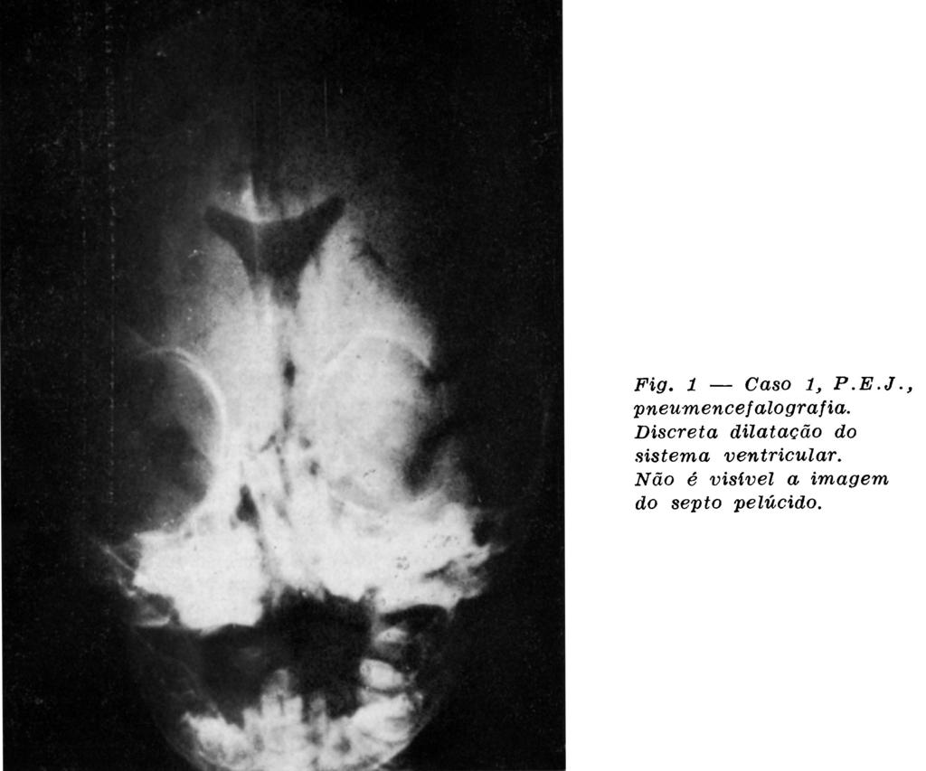 A evolução foi satisfatória e mais dois testes de Gesell evidenciaram melhora do desenvolvimento psicomotor persistindo discreto retardo. CASO 2 L.C.B.