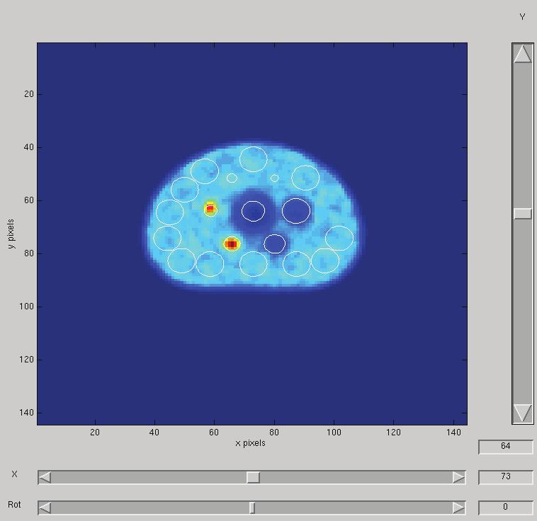 CAPÍTULO 5 RESULTADOS No último processamento teve em conta a posição correta da esfera de 17 mm, que se encontrava inclinada. Figura 30 - Alinhamento das ROIs, tendo em conta a esfera de 22mm.