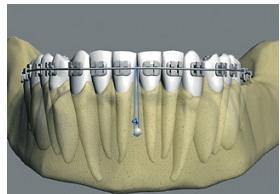 Com a utilização dos implantes, surge uma nova alternativa de ancoragem esquelética em Ortodontia, a qual não permite a movimentação da unidade de reação.