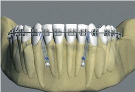 Quando os incisivos estão com boa inclinação axial (Figuras 4 e 5), deve-se fazer com que a linha de ação de força passe o mais próximo possível de centro de resistência dos dentes que serão