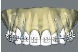 Figuras 4 e 5: Intrusão de incisivos superiores e inferiores com intuito de manter a inclinação axial dos dentes (ARAÚJO et al.