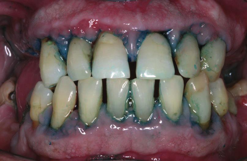 de bolsas periodontais com PS de 5 mm (média de 8mm), papilas interdentais inflamadas, mobilidade grau I, presença de biofilme bacteriano, cálculos subgengivais e halitose.
