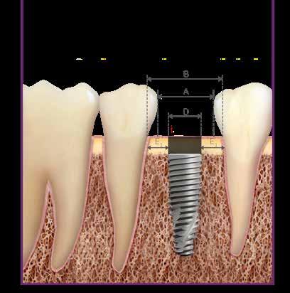 D Diâmetro do Implante (mm) A Largura do Espaço (mm) B Distância entre os dentes adjacentes ao nível ósseo (mm) E 1 Distância denteimplante (mm) 3.5 5.5 6.5 3.75 5.75 6.75 4.0 6.0 7.0 4.3 6.3 7.3 1.
