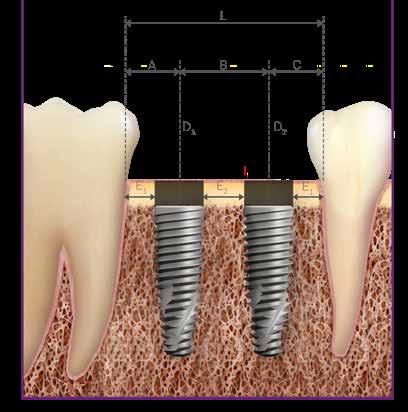 D 1 Diâmetro do Implante (mm) 3.5 3.75 D 2 Diâmetro do Implante (mm) 3.5 3.75 4.0 4.3 5.0 A B C L 4.0 4.3 5.0 3.5 3.7 4.0 7.0 7.3 8.