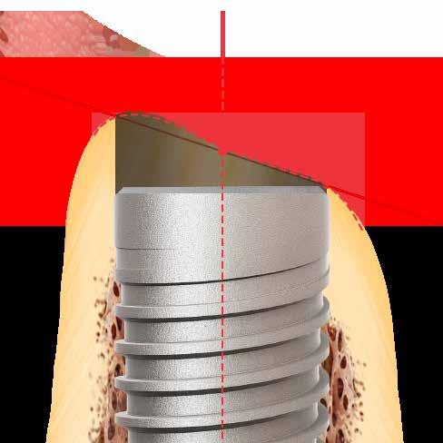 5.1.2 Posição vestibulolingual do Implante A tábua óssea vestibular e palatina deve ter no mínimo 1 mm em espessura, de modo a assegurar a estabilidade do tecido ósseo e as condições dos tecidos